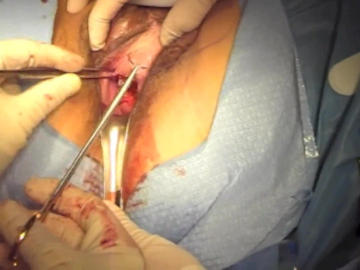 A Teaching Guide for Retropubic Mid-Urethral Sling - SurgeryU by AAGL